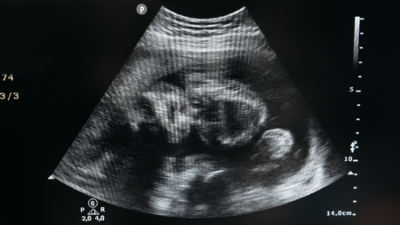 GOP Lawmakers Look to Reverse Controversial Abortion Bill from 2023