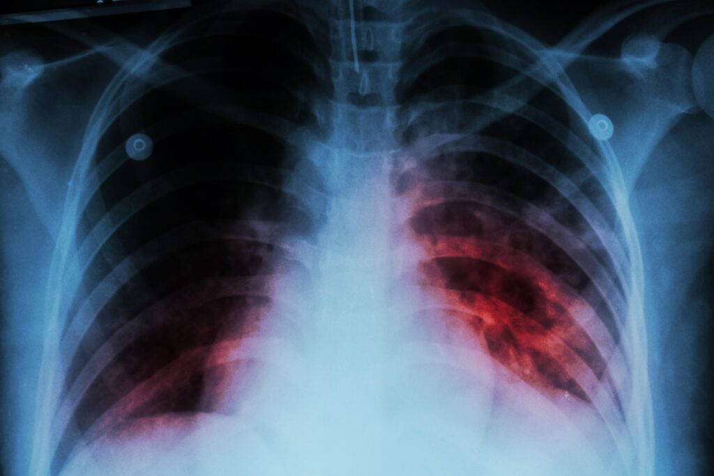 Tuberculosis Outbreak Hits 21 People at Maine’s Biggest Migrant Shelter